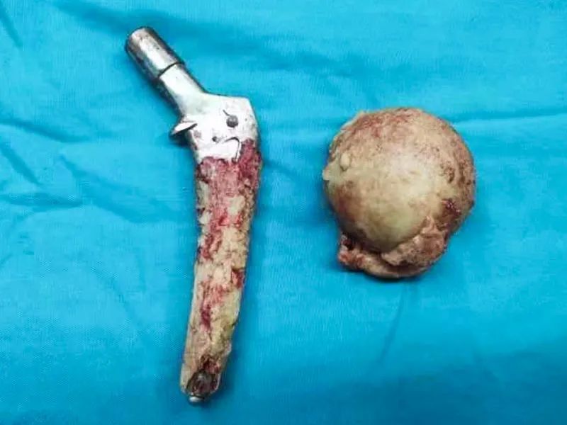 延安市中医医院骨科成功开展一例髋关节翻修手术