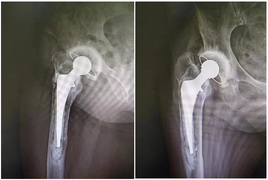 延安市中医医院骨科成功开展一例髋关节翻修手术