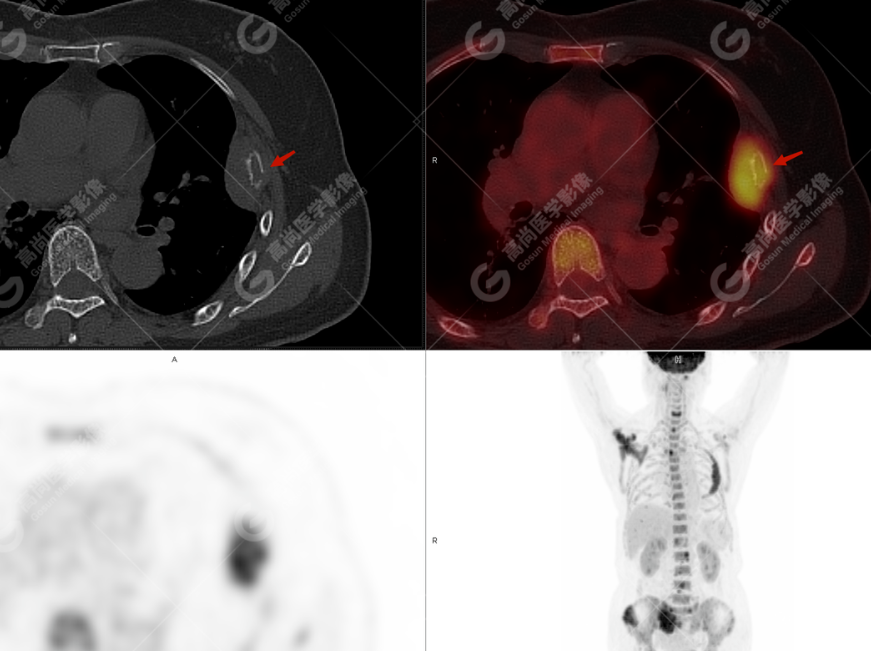 高尚病例：多发性骨髓瘤一例