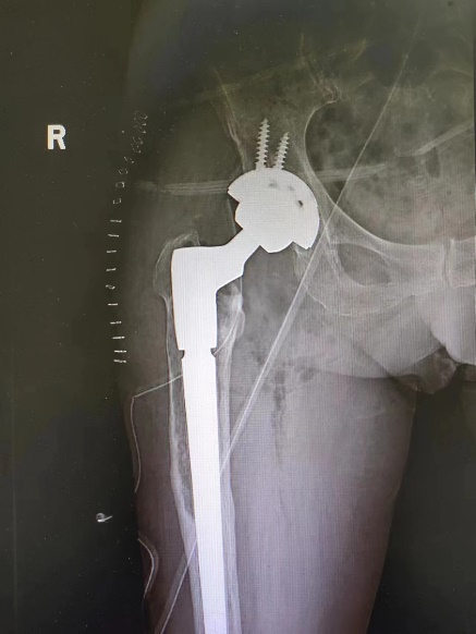 延安市中医医院骨科成功开展一例髋关节翻修手术