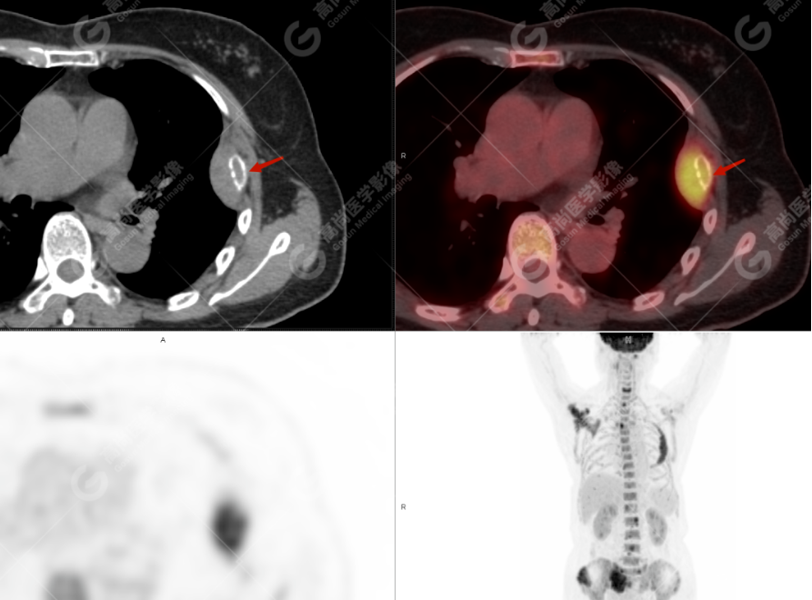 高尚病例：多发性骨髓瘤一例