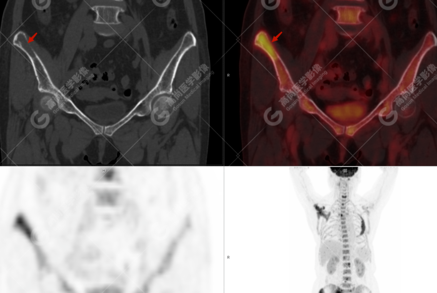 高尚病例：多发性骨髓瘤一例