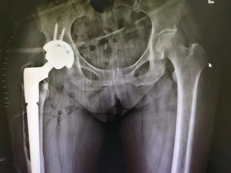 延安市中医医院骨科成功开展一例髋关节翻修手术