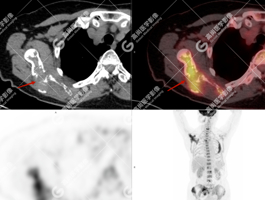 高尚病例：多发性骨髓瘤一例