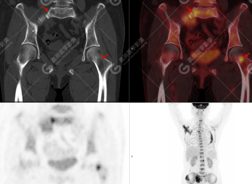 高尚病例：多发性骨髓瘤一例