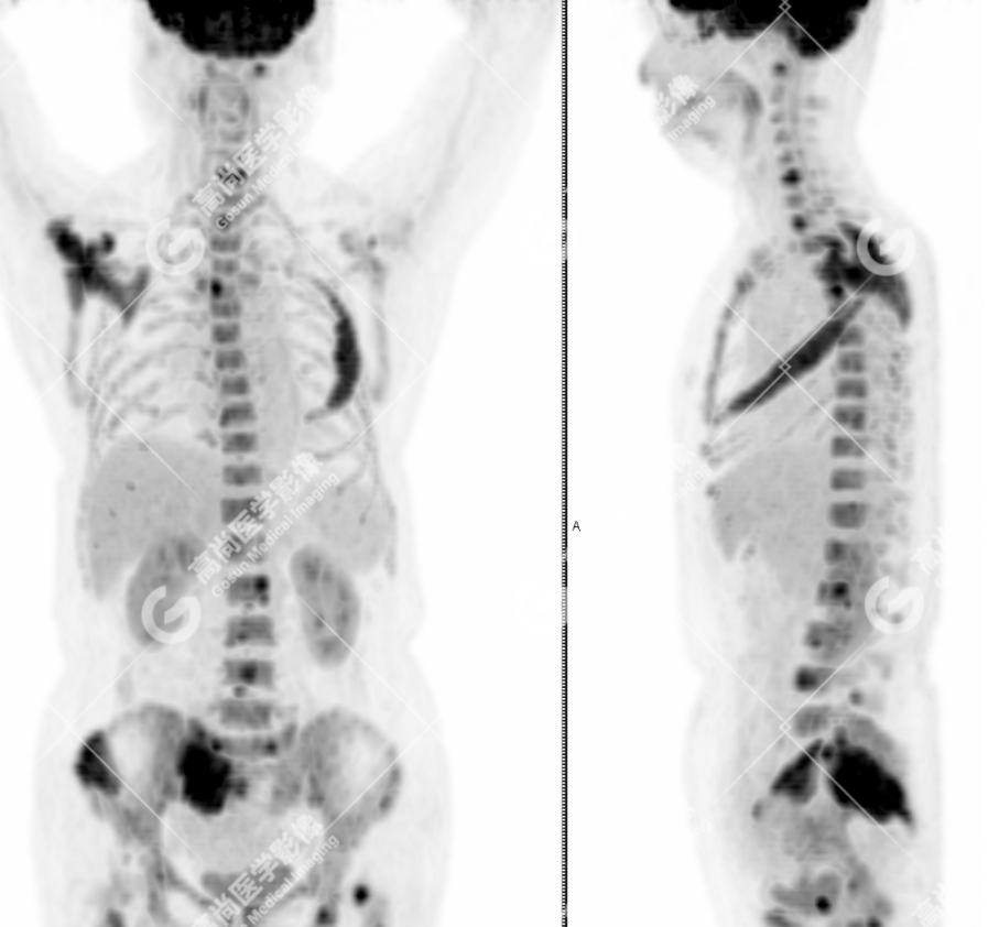 高尚病例：多发性骨髓瘤一例