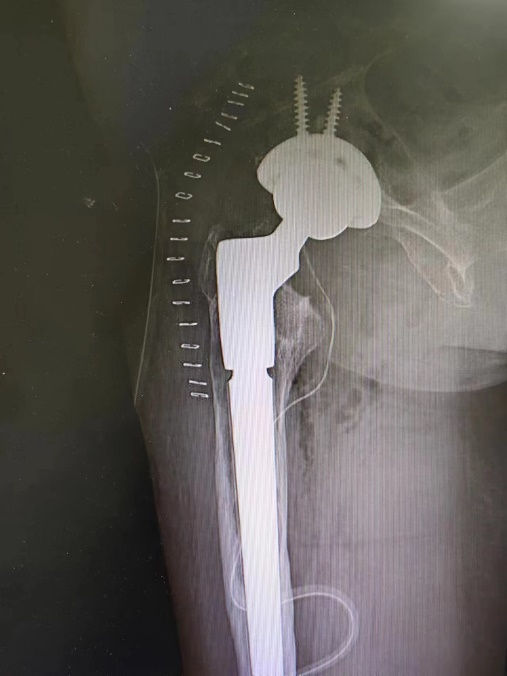 延安市中医医院骨科成功开展一例髋关节翻修手术