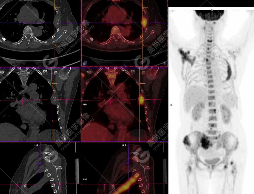 高尚病例：多发性骨髓瘤一例