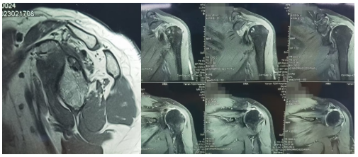 北京大学第三医院延安分院(延安市中医医院)运动医学科微创技术治疗关节病痛