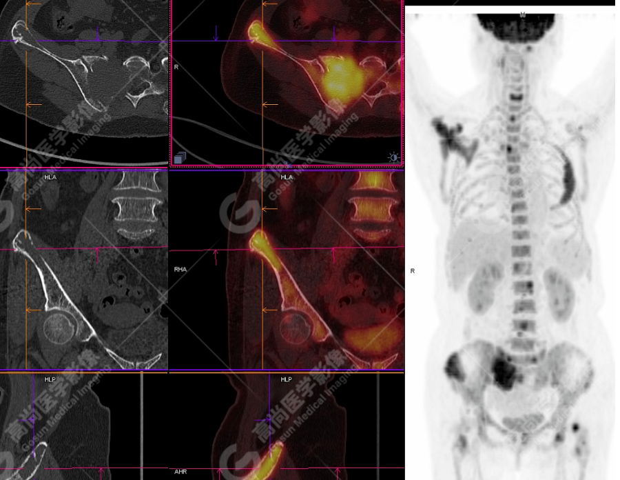 高尚病例：多发性骨髓瘤一例