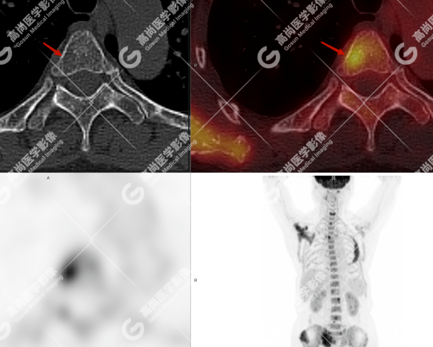 高尚病例：多发性骨髓瘤一例