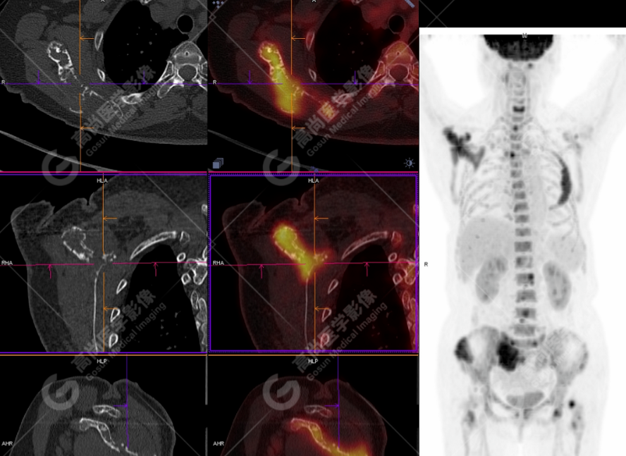 高尚病例：多发性骨髓瘤一例