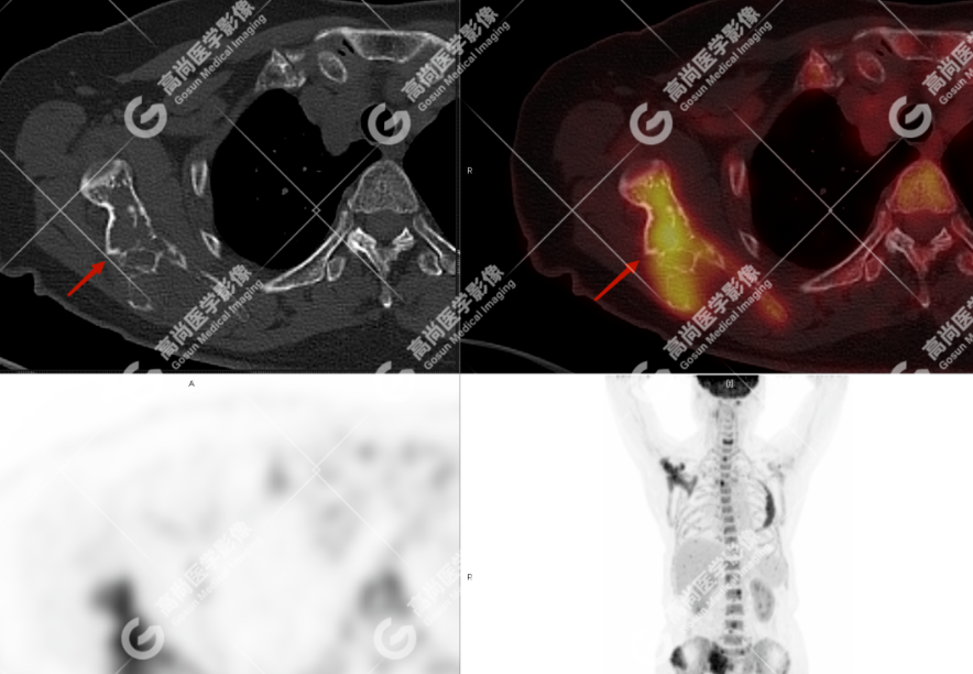 高尚病例：多发性骨髓瘤一例