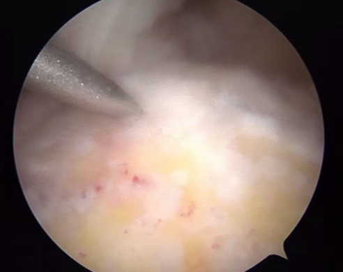 北京大学第三医院延安分院(延安市中医医院)运动医学科微创技术治疗关节病痛