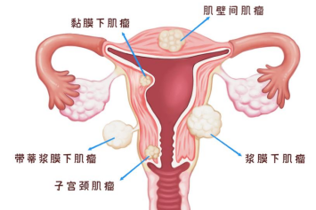 子宫肌瘤如何排除是子宫肉瘤？