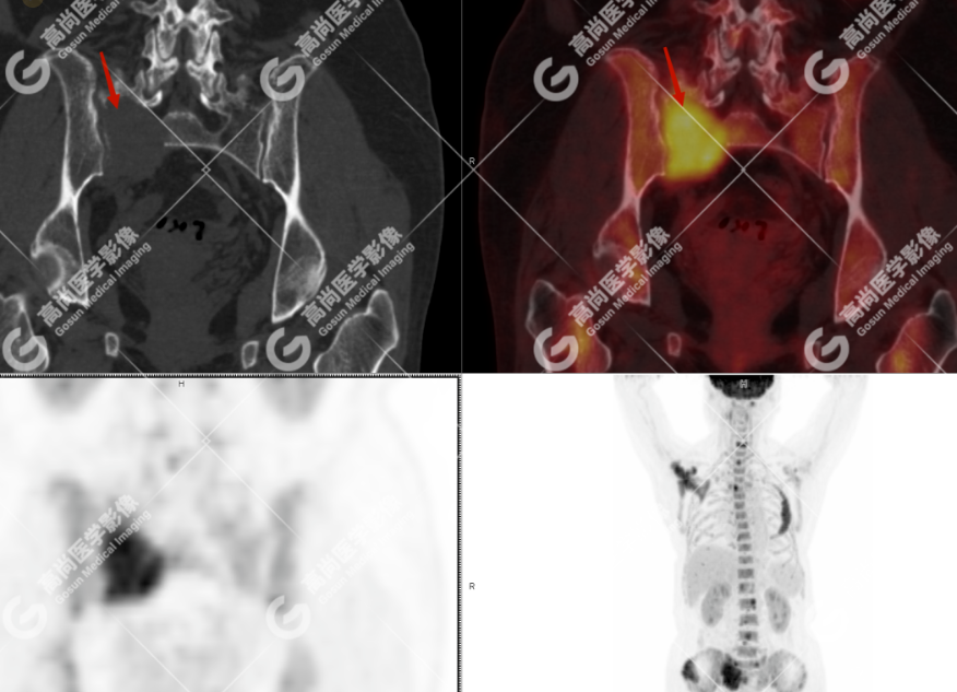 高尚病例：多发性骨髓瘤一例