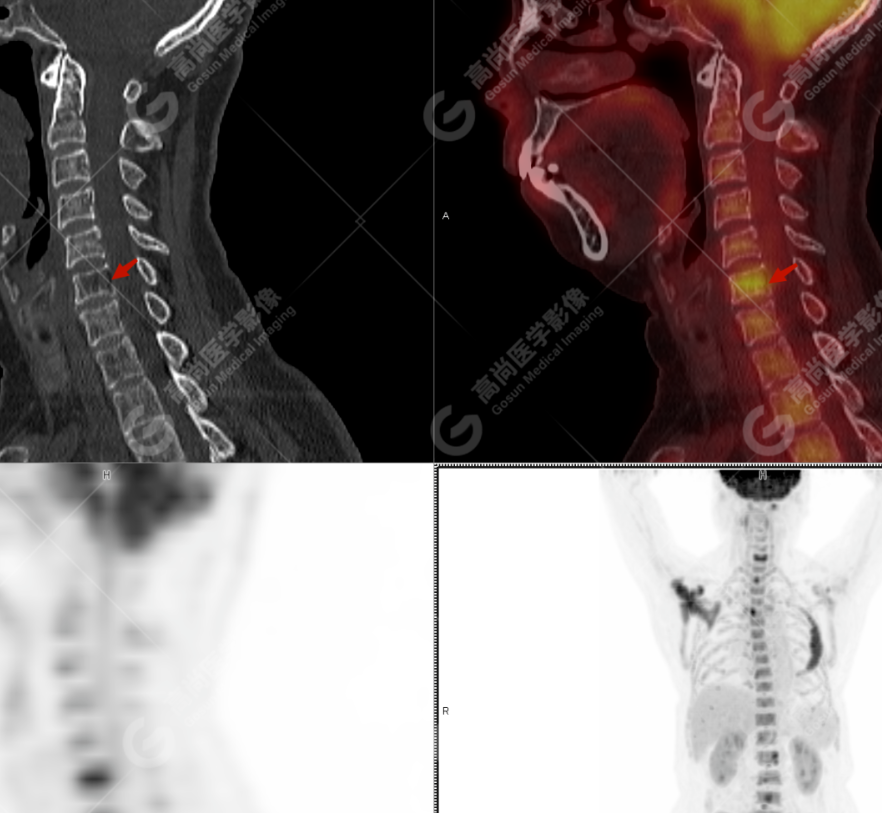 高尚病例：多发性骨髓瘤一例