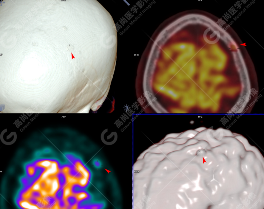 高尚病例：多发性骨髓瘤一例