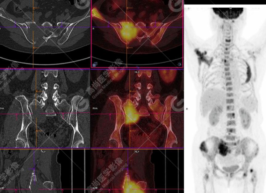 高尚病例：多发性骨髓瘤一例