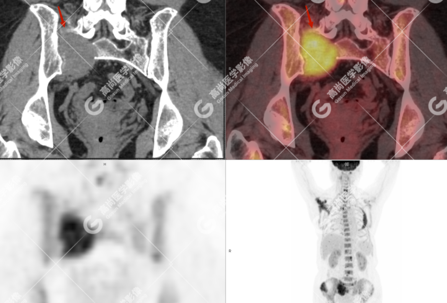 高尚病例：多发性骨髓瘤一例