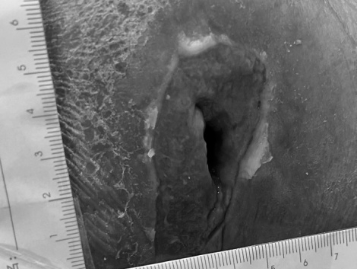 谨防「躺」出来的病，郑州大学第五附属医院为截瘫老年患者成功实施手术！