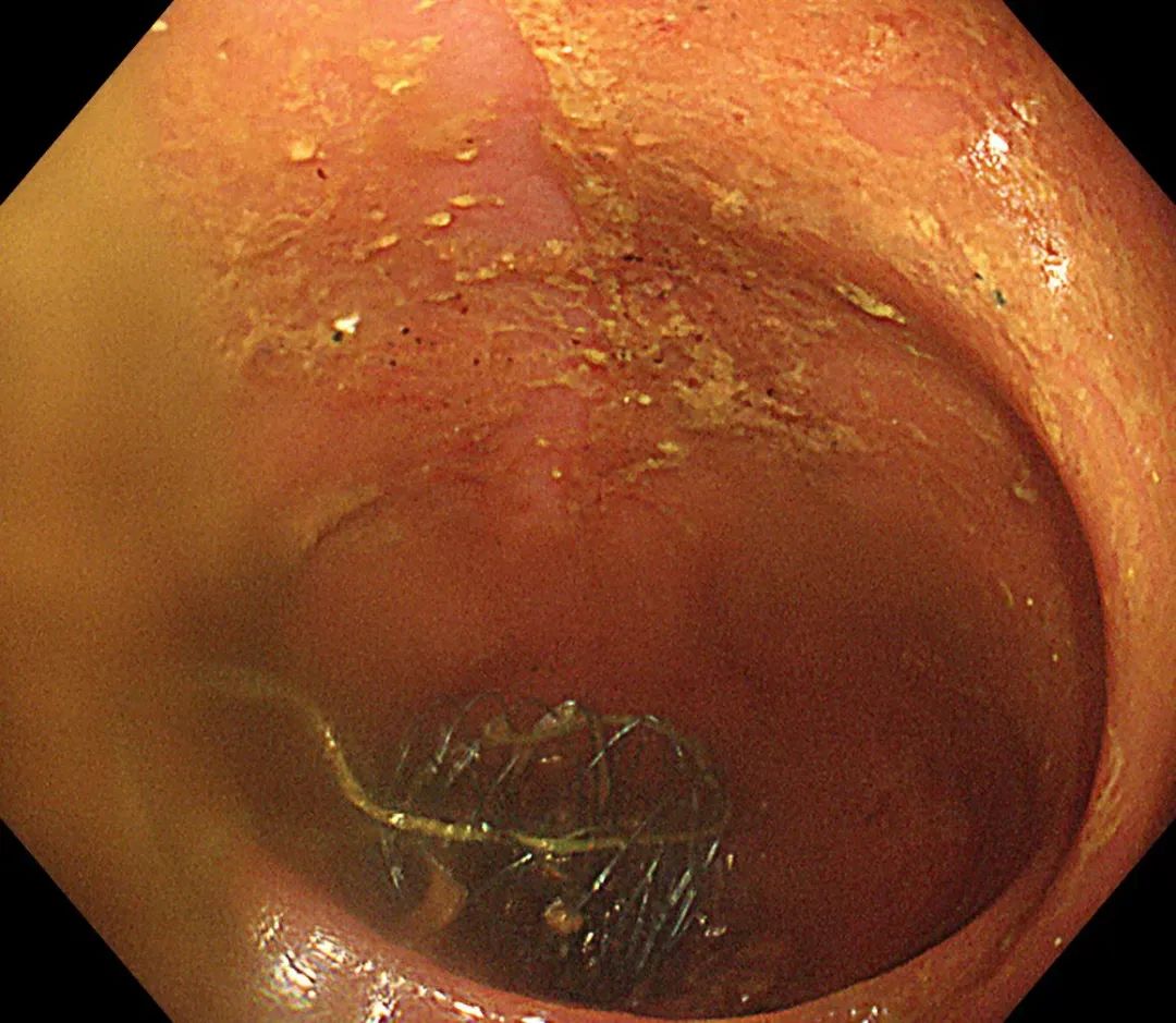 北京大学第三医院延安分院(延安市中医医院)消化内科成功开展院内首例肠道支架置入术
