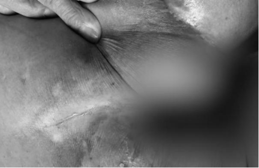 谨防「躺」出来的病，郑州大学第五附属医院为截瘫老年患者成功实施手术！