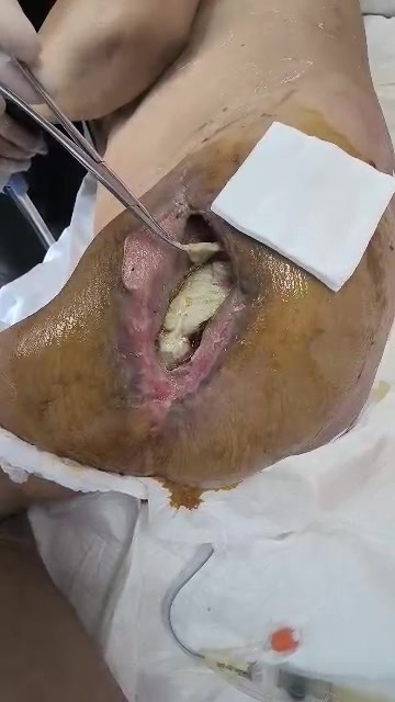 病例讨论70岁女性左大腿压疮并感染性窦道三月下一步治疗方案