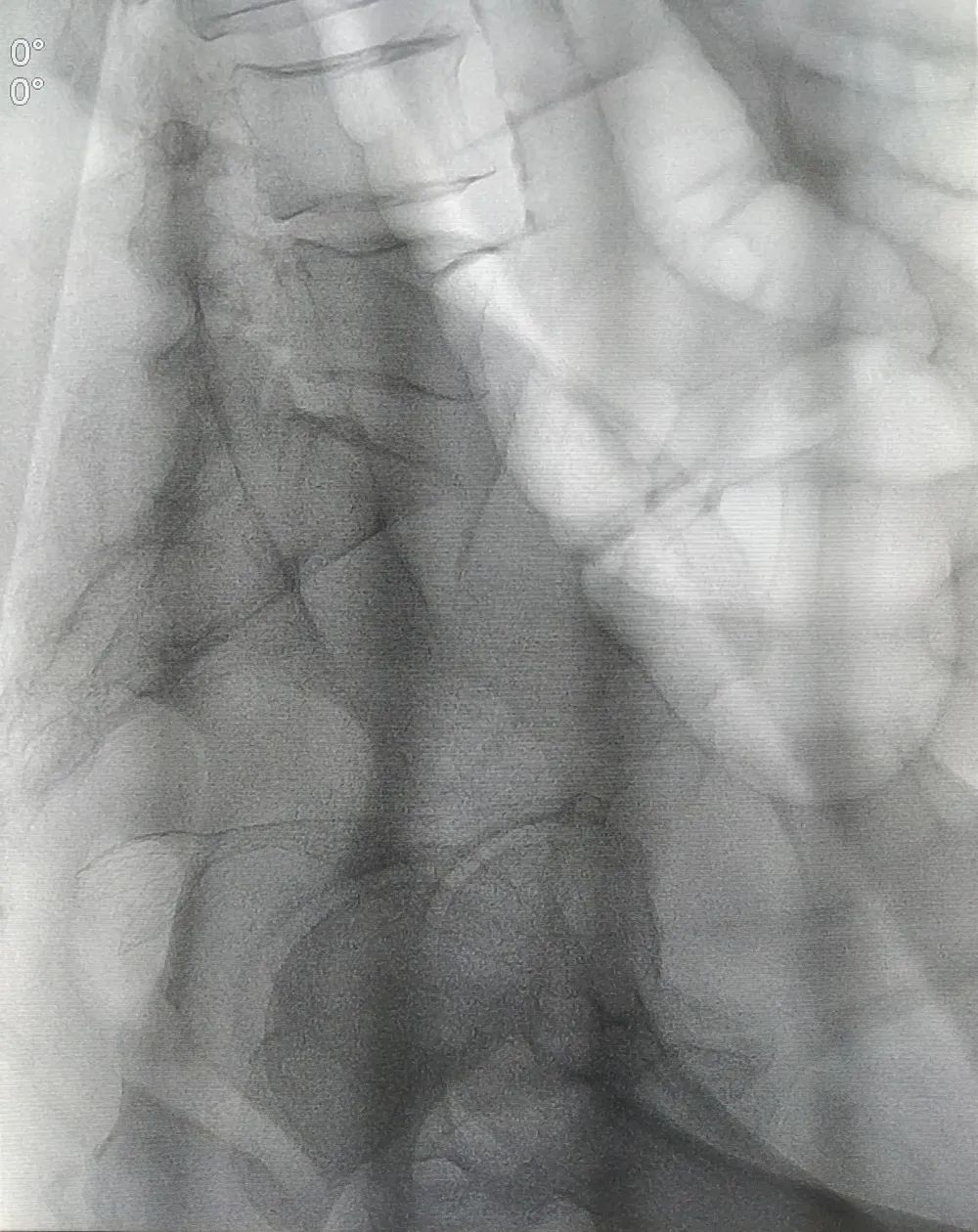 北京大学第三医院延安分院(延安市中医医院)消化内科成功开展院内首例肠道支架置入术