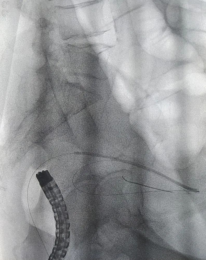 北京大学第三医院延安分院(延安市中医医院)消化内科成功开展院内首例肠道支架置入术