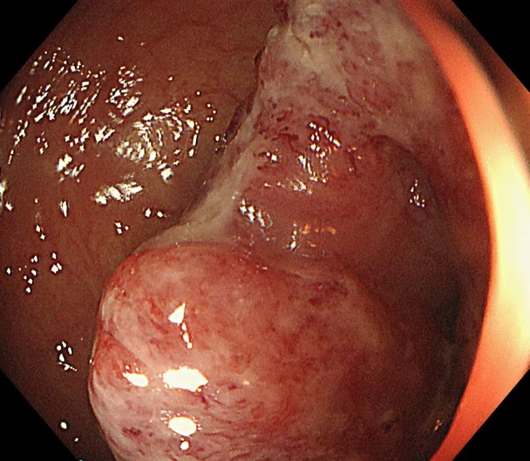 北京大学第三医院延安分院(延安市中医医院)消化内科成功开展院内首例肠道支架置入术