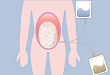 减少包裹性腹膜硬化，该如何选择腹膜透析液？