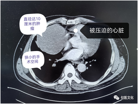 堪比有一拳头打在心脏上！不开胸，胸外科微创团队妙手摘除