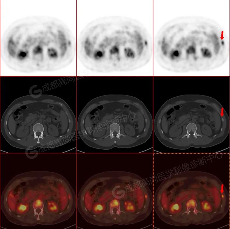 高尚病例：惰性 b 细胞淋巴瘤 PET/CT 诊断及疗效评估 1 例