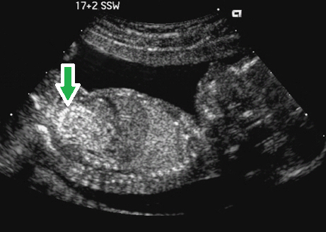 B 超见胎儿肠内强回声,是不是病?