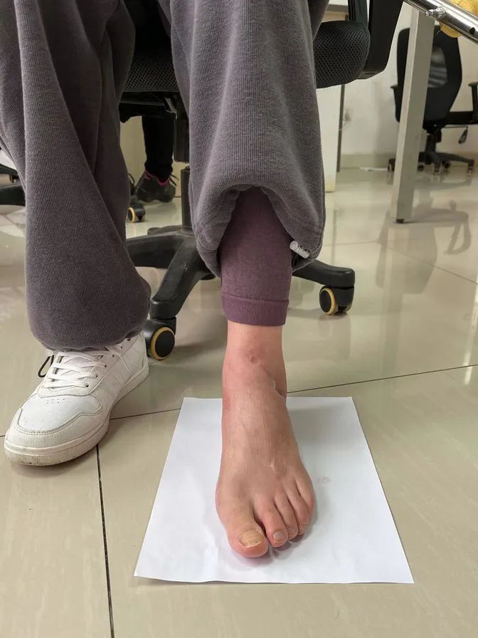 河南信合医院创伤中心骨科团队成功完成一例「保肢」手术