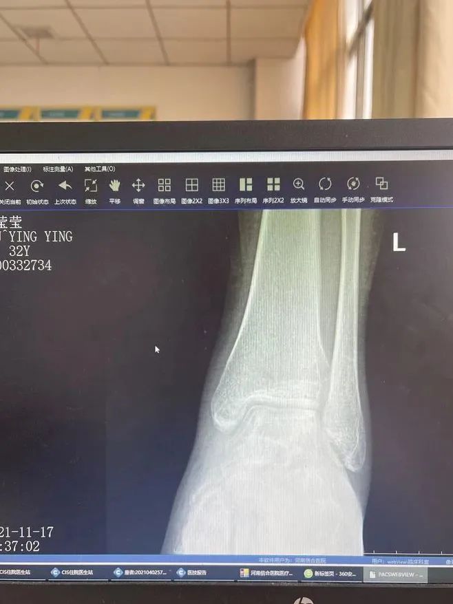 河南信合医院创伤中心骨科团队成功完成一例「保肢」手术