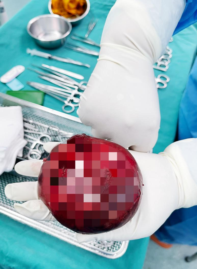 胎儿肿瘤压迫气道,一出生就经历浩劫!