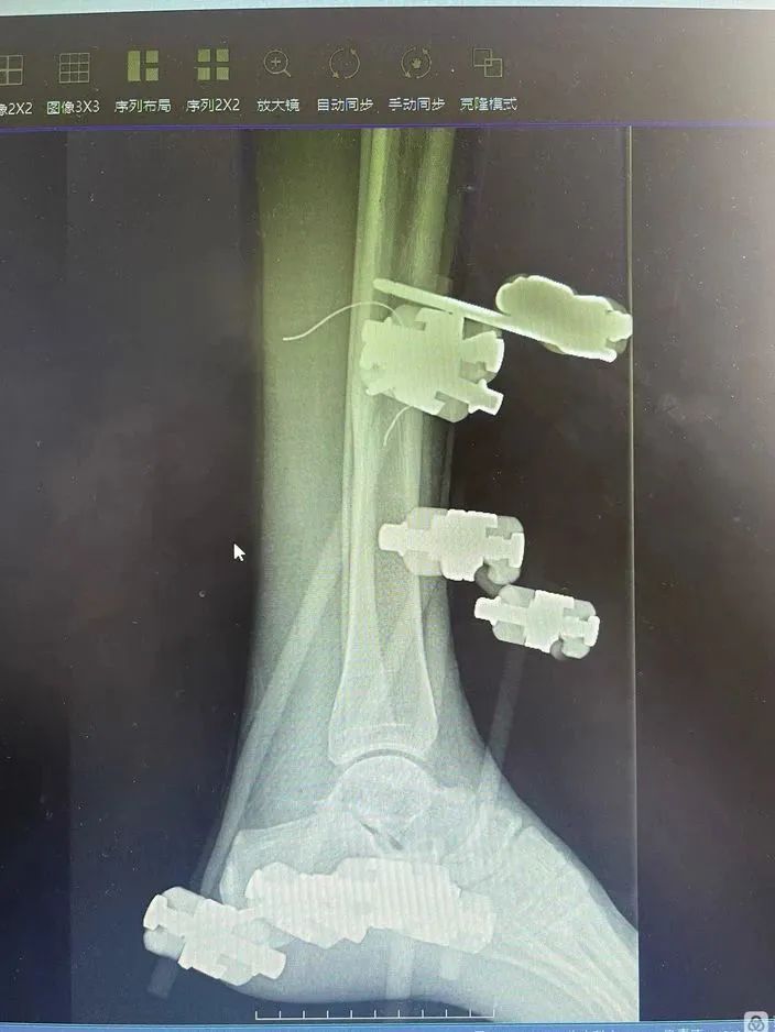 河南信合医院创伤中心骨科团队成功完成一例「保肢」手术