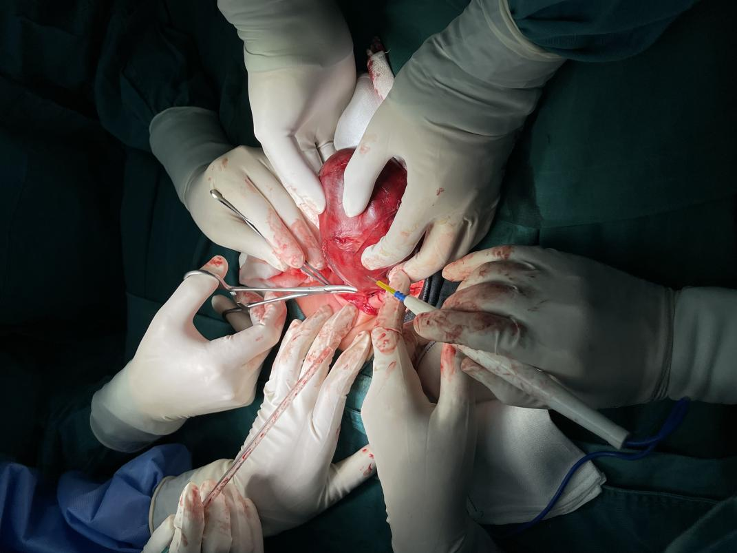 胎儿肿瘤压迫气道,一出生就经历浩劫!