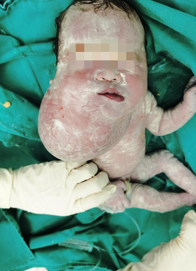 胎儿肿瘤压迫气道,一出生就经历浩劫!