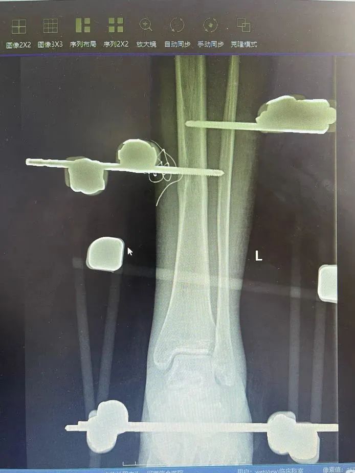 河南信合医院创伤中心骨科团队成功完成一例「保肢」手术