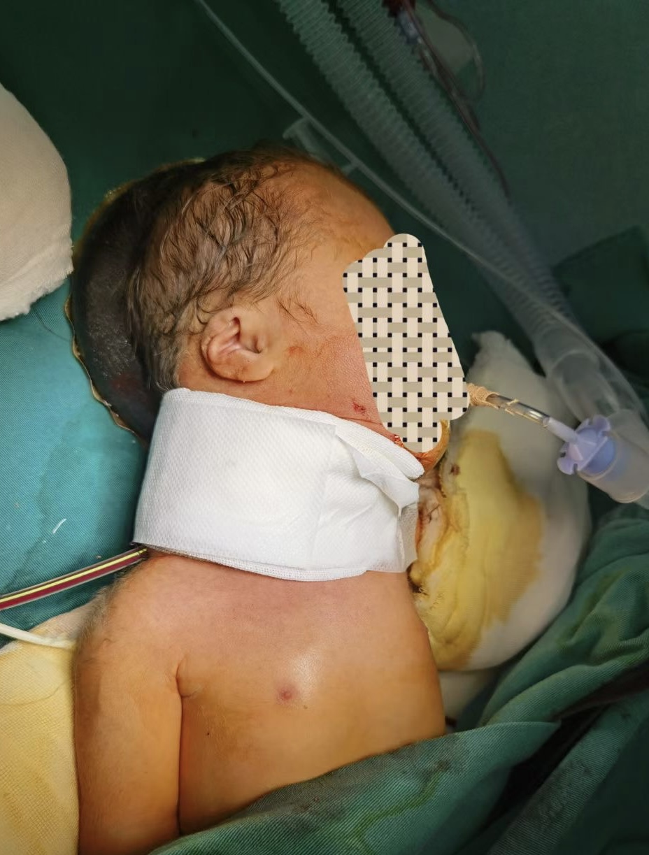 胎儿肿瘤压迫气道,一出生就经历浩劫!