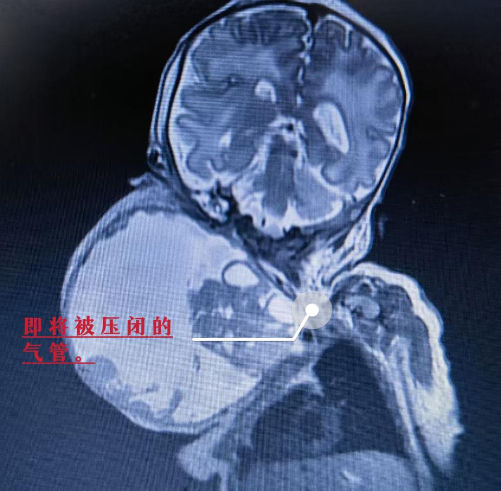 胎儿肿瘤压迫气道,一出生就经历浩劫!