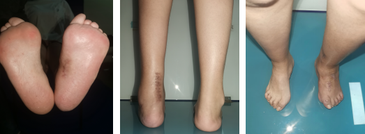 徐州仁慈医院足踝外科团队成功为双侧高弓足畸形女孩手术治疗