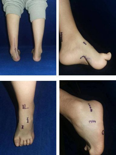 徐州仁慈医院足踝外科团队成功为双侧高弓足畸形女孩手术治疗