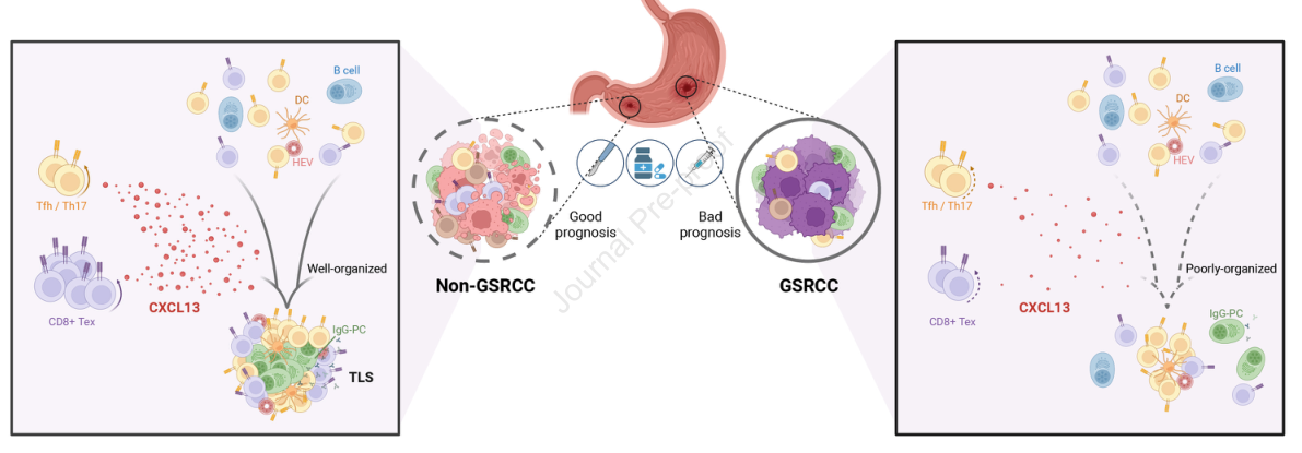 Gastroenterology| 浙江大学陈健/汪冽团队从单细胞水平分析胃印戒细胞癌微环境高度恶性潜在机理