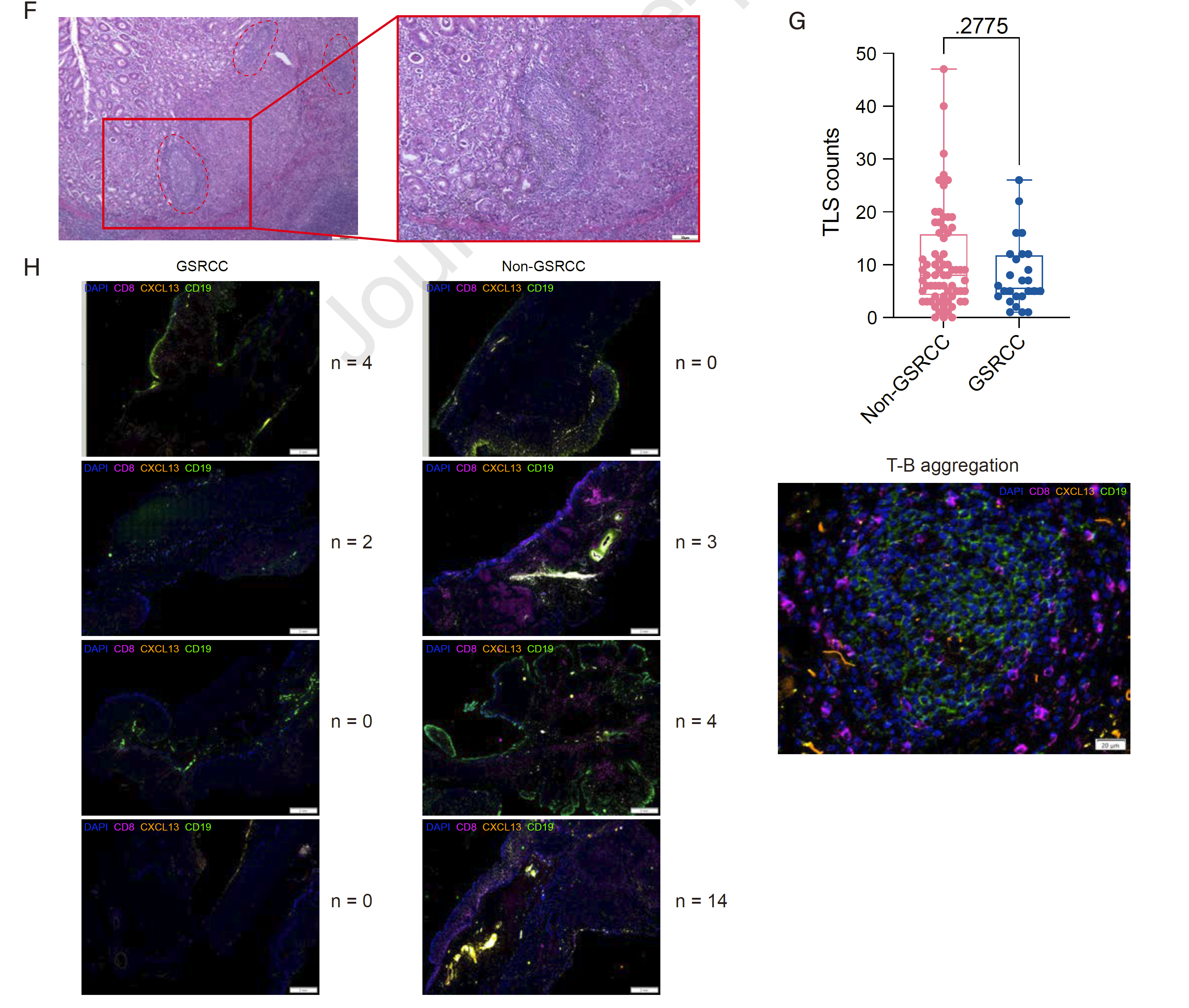 Gastroenterology| 浙江大学陈健/汪冽团队从单细胞水平分析胃印戒细胞癌微环境高度恶性潜在机理