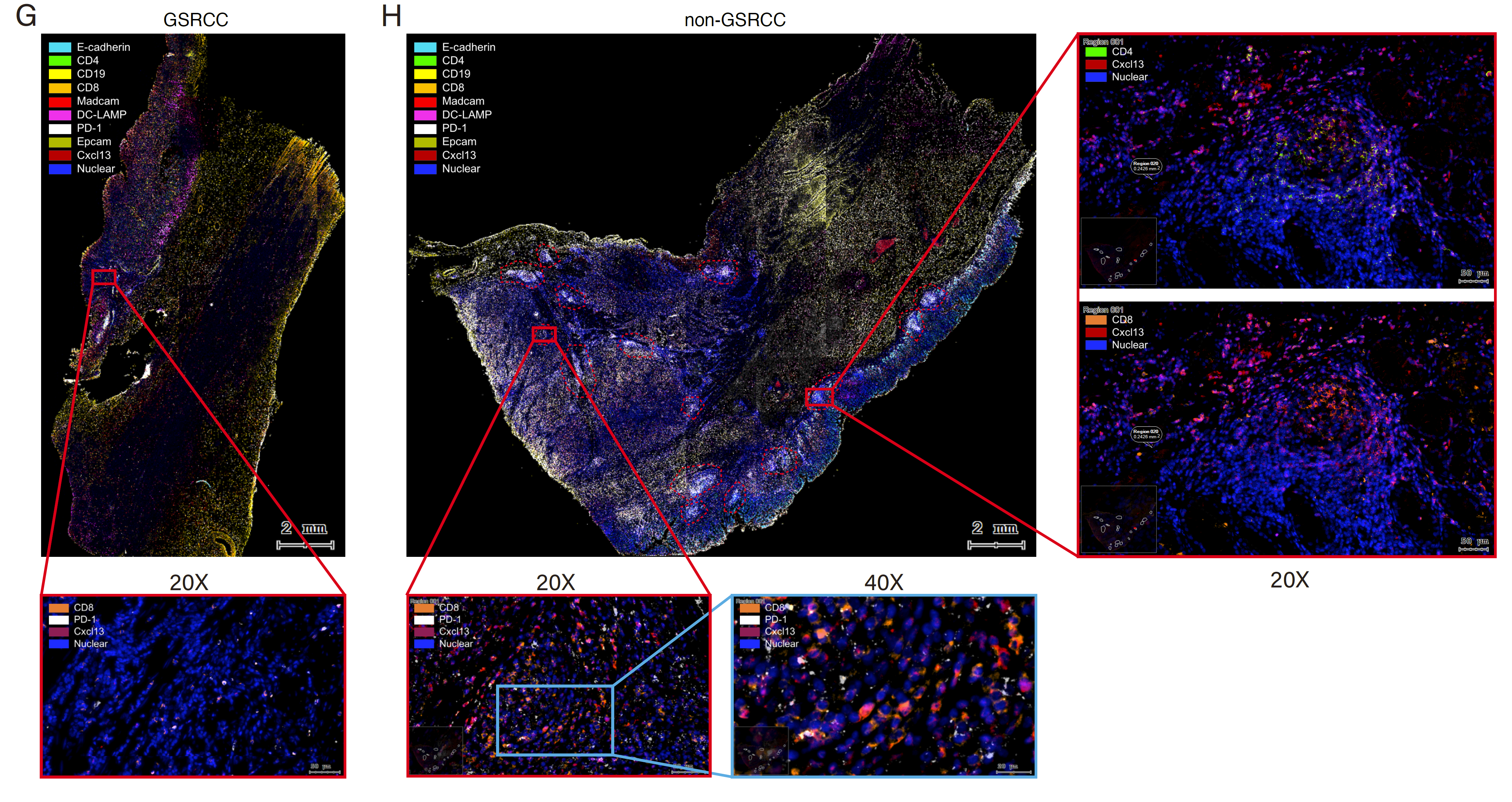 Gastroenterology| 浙江大学陈健/汪冽团队从单细胞水平分析胃印戒细胞癌微环境高度恶性潜在机理