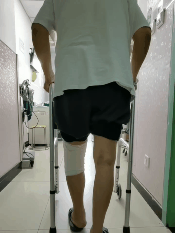 警惕腰腿痛！老人膝盖疼 10 年，换上人工关节